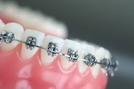braces and implants