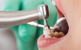 Dental Exams and Cleaning Dental Exams and Cleaning